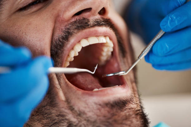 Best Chipped Tooth Repair Near Me  in Pacific, MO